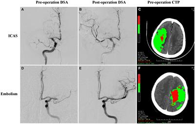 CT perfusion for predicting intracranial atherosclerotic middle cerebral artery occlusion